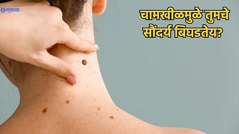 Moles On Skin Treatment