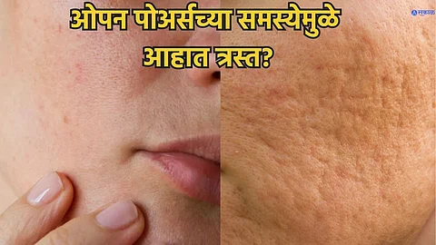 open pores on face treatment