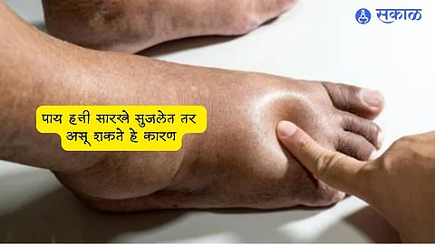 Filariasis Disease