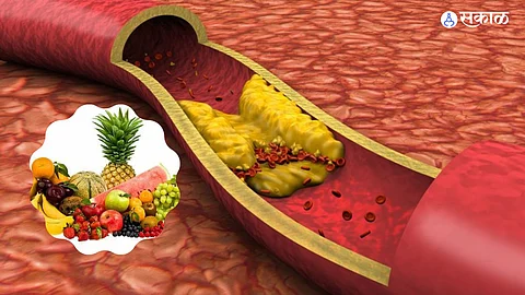 High Cholesterol