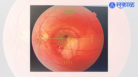 Laser light burns to the inner part of the eye.