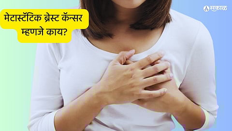 Metastatic Breast Cancer