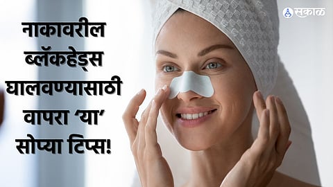 Blackheads