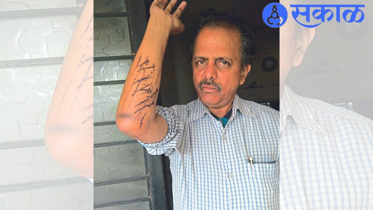 Suyog Tade showing hand injured in cat attack