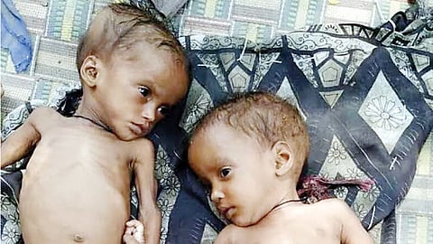 Malnourished Childrens