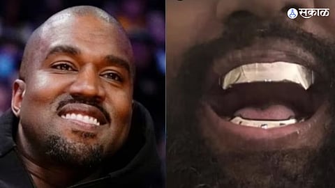 Kanye West Titanium Teeth