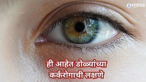Eye Cancer Symptoms: ही आहेत डोळ्यांच्या कर्करोगाची सुरुवातीची लक्षणे, जाणून घ्या कोणत्या लोकांना असतो जास्त धोका