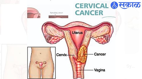 Risk of cervical cancer in women