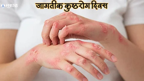 World Leprosy Day 2024 : कुष्ठरोग म्हणजे काय आणि कसा पसरतो हा रोग? जाणून घ्या त्याची लक्षणे, उपचार