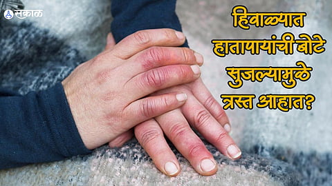 Health Care News : हिवाळ्यात हातापायांची बोटे सुजल्यामुळे त्रस्त आहात? मग हे उपाय ट्राय करून पाहा, लगेच मिळेल आराम