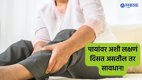 Diabetes Symptoms: पायांवर अशी लक्षणं दिसत असतील तर सावधान! ही डायबिटीजची सुरुवात असू शकते