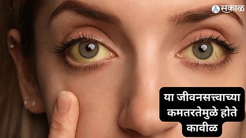 Jaundice : शरीरात या जीवनसत्त्वाच्या कमतरतेमुळे होते कावीळ, अशी ओळखा लक्षणं...