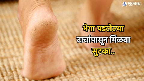 Cracked Heels : भेगा पडलेल्या टाचांपासून मिळवा सुटका, करून पाहा 'हे' घरगुती उपाय