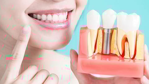 Dental Implant