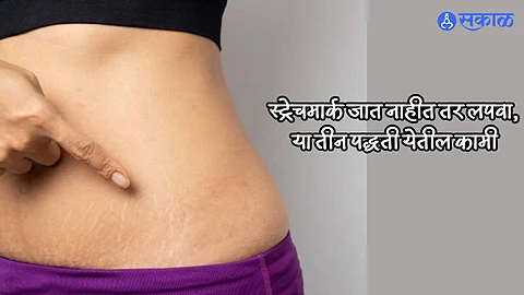 Beauty Tips : स्ट्रेचमार्क जात नाहीत तर लपवा, या तीन पद्धती येतील कामी 