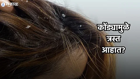 Hair Mask : कोंड्यामुळे त्रस्त आहात? 'या' आयुर्वेदिक मास्कमुळे केसांच्या समस्या होतील दूर
