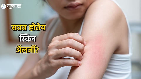 Skin Allergy