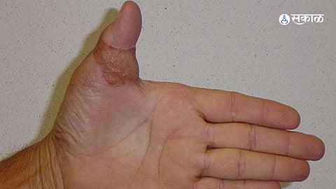 Thumb Transplant