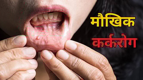 Oral Cancer Symptoms