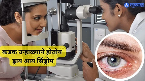 Dry Eye Syndrome : उन्हाळ्यात लोकांना होत आहे ड्राय आय सिंड्रोम; वेळीच ओळखा लक्षणे!