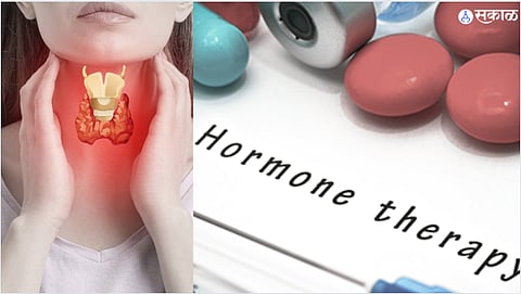 Preventing Complications of Hypothyroidism with Hormone Therapy