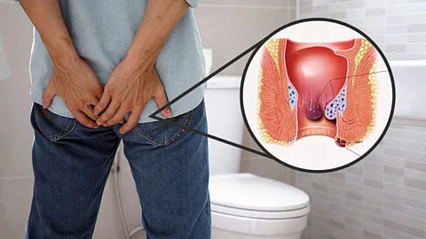 Piles Symptoms