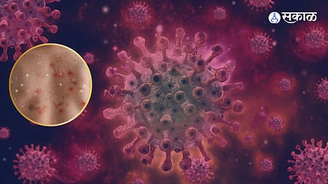 Monkeypox Virus In Pakistan