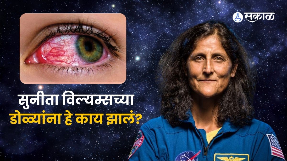 sunita williams facing eyesight issues in space