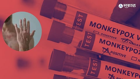 Monkeypox : मंकीपॉक्सला घाबरण्याची गरज नाही; फक्त 'ही' 6 लक्षणे आढळल्यास लगेचच घ्या उपचार