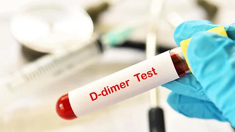 d-dimer test