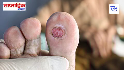 Diabetic Foot Ulcer