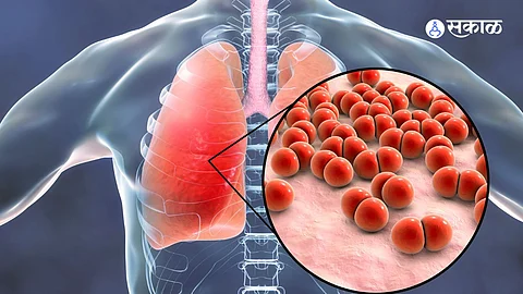 Pneumonia