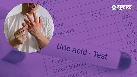 Uric Acid Home Remedies: