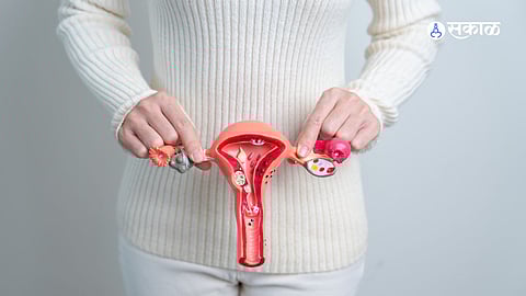 Cervical Cancer: