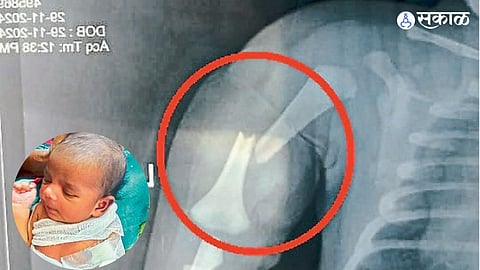 Newborn baby's hand fracture Case