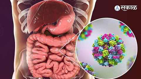 Norovirus symptoms and causes