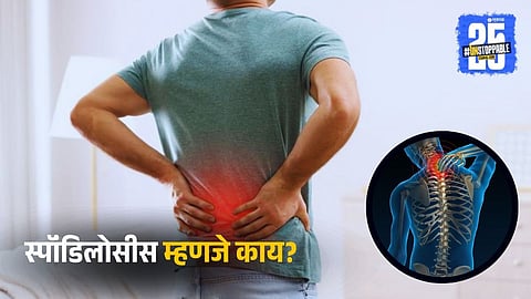 Sponylosis Types, Causes, Treatment,