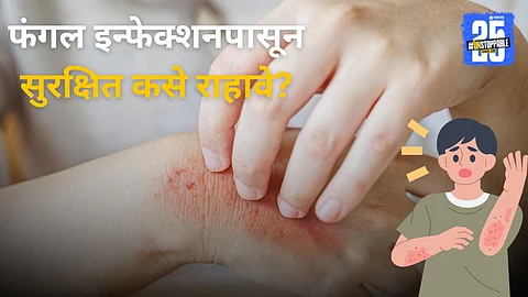 Fungal Infections