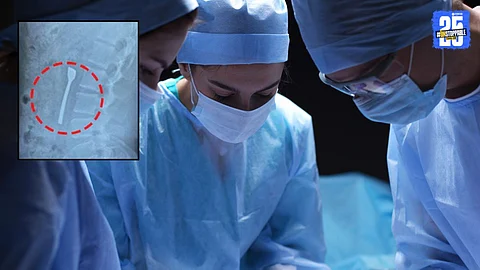 An X-ray image showing a steel spoon stuck inside a young man's intestine; doctors successfully removed it within 30 minutes without major surgery.