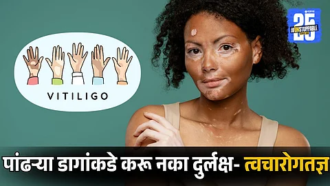 World Vitiligo Day 2025