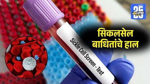 Sickle Cell Patients Denied Treatment Due to Lack of Hydroxyurea