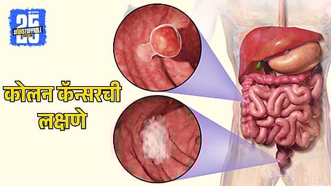 Early Signs of Colon Cancer
