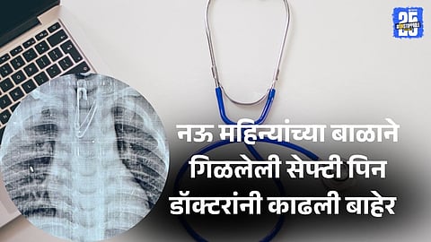 ...अन् आईचे अश्रू बदलले आनंदाश्रूत, नऊ महिन्यांच्या बाळाने गिळलेली सेफ्टी पिन डॉक्टरांनी काढली बाहेर