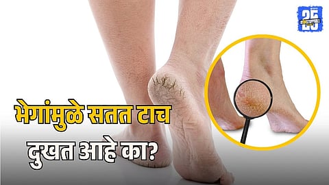 Cracked Heels Pain Relief