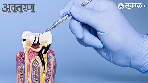 Gum Disease And Stroke Connection