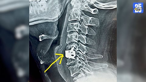 When Neck Pain Radiates to Arm and Fingers