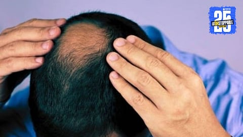 Young adults experiencing hair fall while checking their scalp