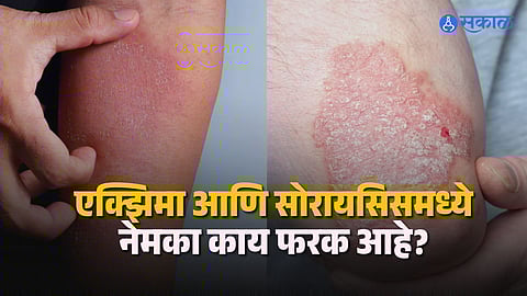 Symptoms of Eczema vs Psoriasis