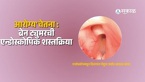 Brain Tumor Detected Through MRI