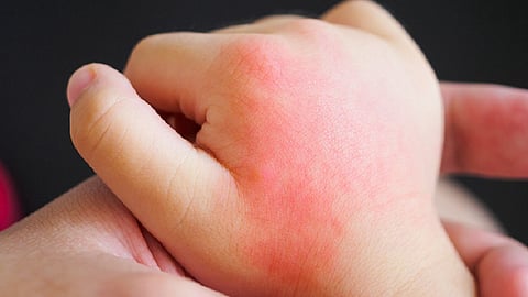 सावध व्हा, मुंबईत कोरोनानंतर मुलांना 'या' आजाराची लागण...